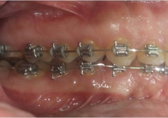 Mordida inicial - Clínica Cliniface