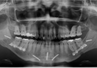 Raio x final - Clínica Cliniface