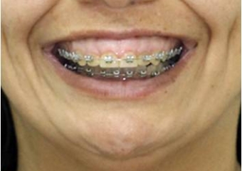 Sorriso inicial - Clínica Cliniface