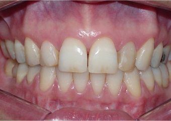 Mordida final - Clínica Cliniface