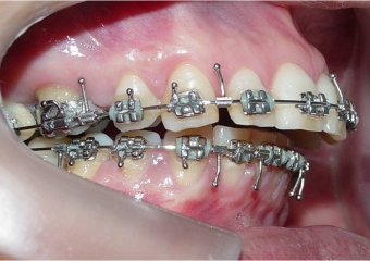 Mordida inicial - Clínica Cliniface