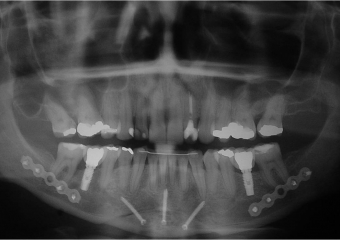 Mordida final - Clínica Cliniface