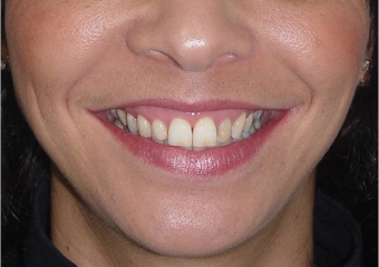 Sorriso final - Clínica Cliniface