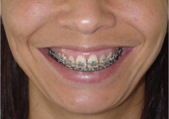 Sorriso inicial - Clínica Cliniface