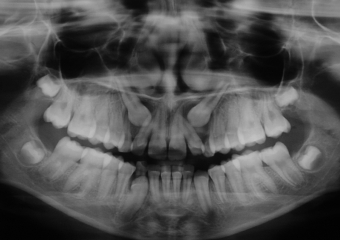 Rx Panorâmica inicial - 2014 - Clínica Cliniface