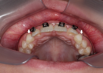 Caninos decíduos (de leite)  - Clínica Cliniface