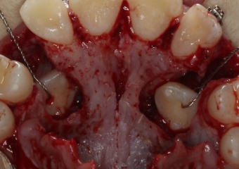 Cirurgia com fio de aço instalado para tracionamento dos caninos permanentes - Clínica Cliniface