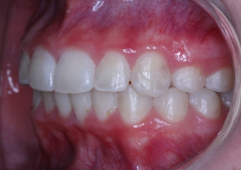 Lateral final - 2019 - Clínica Cliniface