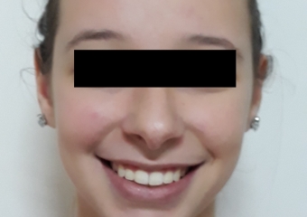 Sorriso final - 2019 - Clínica Cliniface