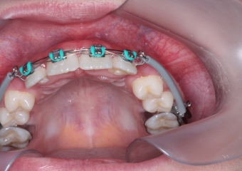 Dentes em tracionamento - Clínica Cliniface