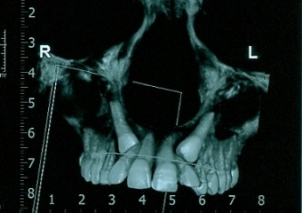 Tomografia - caninos inclusos - Clínica Cliniface