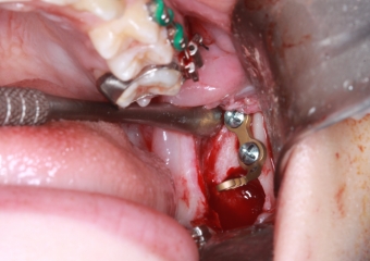Extração dos 4 terceiros molares   - Instalação de placas de ancoragem - Clínica Cliniface