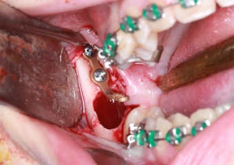 Extração dos 4 terceiros molares  - Instalação de placas de ancoragem - Clínica Cliniface