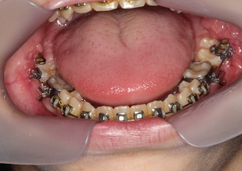 Elementos 37 e 47, respondendo bem ao tracionamento - Clínica Cliniface