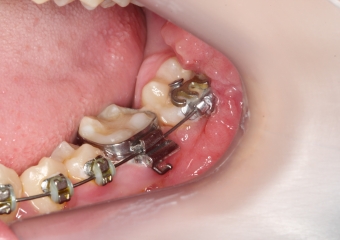 Elemento 37, já em posição habitual - Clínica Cliniface