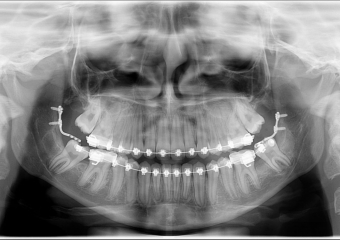 Rx Panorâmico, com os dentes em fase final de tracionamento - Clínica Cliniface