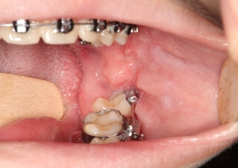 Paciente na fase final da ortodontia - Clínica Cliniface