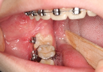 Paciente na fase final da ortodontia - Clínica Cliniface