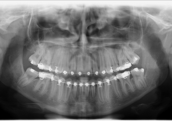 Rx Panorâmico Final, dentes totalmente posicionados e placas removidas - Clínica Cliniface
