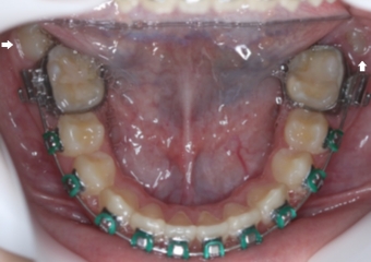 Oclusal inferior com segundos molares em posição inadequada - Clínica Cliniface