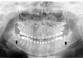 Rx Panorâmico - Pré cirúrgico, com os elementos 37 e 47 impactados - Clínica Cliniface