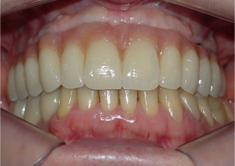 Prótese fixa superior em porcelana - Clínica Cliniface