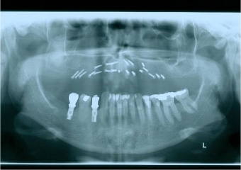 Raio x após enxerto de ilíaco - Clínica Cliniface