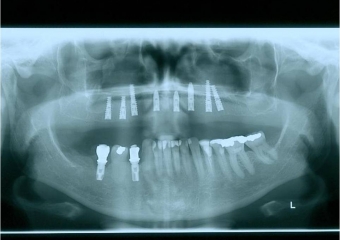 Raio x após instalação dos implantes superiores Cone Morse - Clínica Cliniface