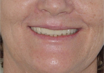 Sorriso final, do caso terminado em fevereiro de 2014 - Clínica Cliniface