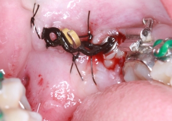 Dentes em tracionamento, imediatamente após a cirurgia - Clínica Cliniface