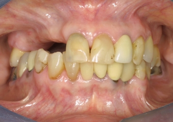 Inicialmente a paciente nos procurou, para instalação de implantes em região posterior de maxila e mandíbula - Clínica Cliniface