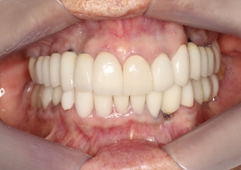 Intra oral pré cirúrgico, com elemento 21 fraturado   - Clínica Cliniface