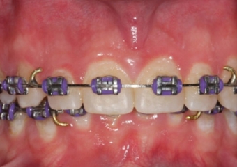 Mordida inicial - Clínica Cliniface