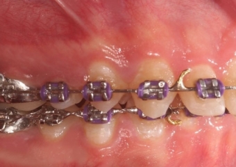 Mordida inicial - Clínica Cliniface