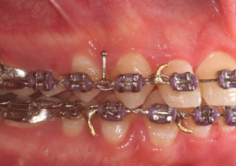 Mordida após a cirurgia - Clínica Cliniface