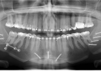 Raio x após a cirurgia - Clínica Cliniface