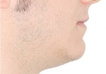 Perfil após a cirurgia - Clínica Cliniface