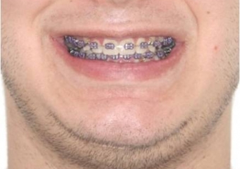 Sorriso inicial - Clínica Cliniface