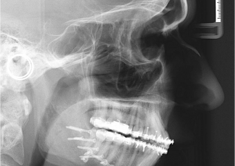 Telerradiografia após a cirurgia - Clínica Cliniface