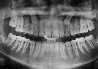 Rx Panorâmico - Caninos inclusos e intra-ósseos - Clínica Cliniface
