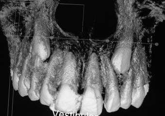 Tomografia - Caninos inclusos e intra-ósseos - Clínica Cliniface