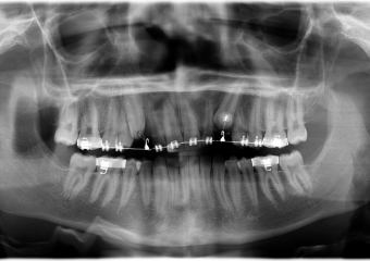 Rx Panorâmico - Caninos respondendo ao tracionamento - Clínica Cliniface