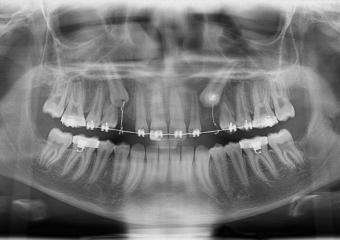 Rx Panorâmico - Caninos respondendo ao tracionamento - Clínica Cliniface