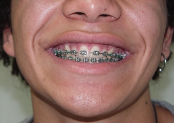 Sorriso - Caninos em posição - Clínica Cliniface