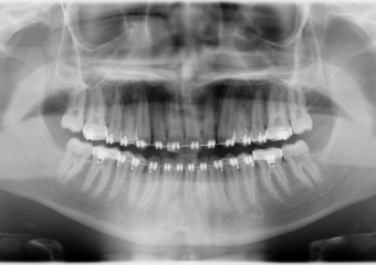 Rx Panoramico - Tracionamento finalizado - Clínica Cliniface