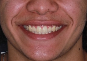 Sorriso com tratamento ortodôntico finalizado  - Clínica Cliniface