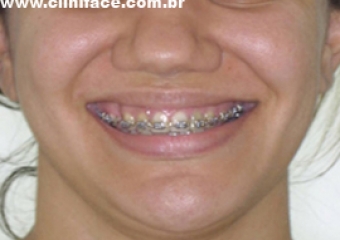 Imagem inicial apresentado assimetria de face - Clínica Cliniface