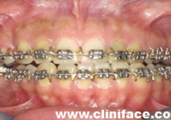 Imagem mordida inicial - Clínica Cliniface