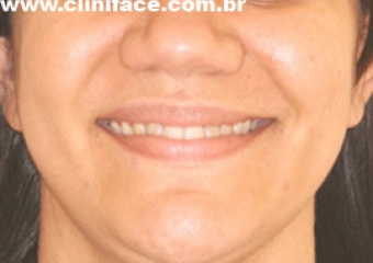 Imagem após a remoção do aparelho - Clínica Cliniface