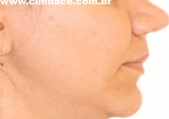 Imagem perfil após a remoção do aparelho - Clínica Cliniface